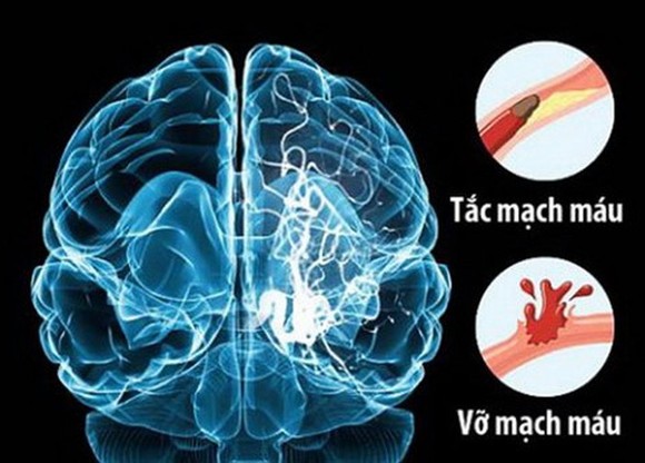 ĐBSCL: Mỗi năm có hơn 10.000 trường hợp đột quỵ ảnh 1