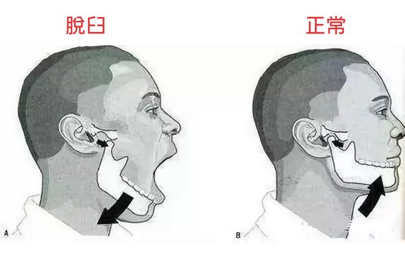 或者当你正张开大嘴打哈欠时,你突然听到自己的腮帮子发出哢嚓的声音