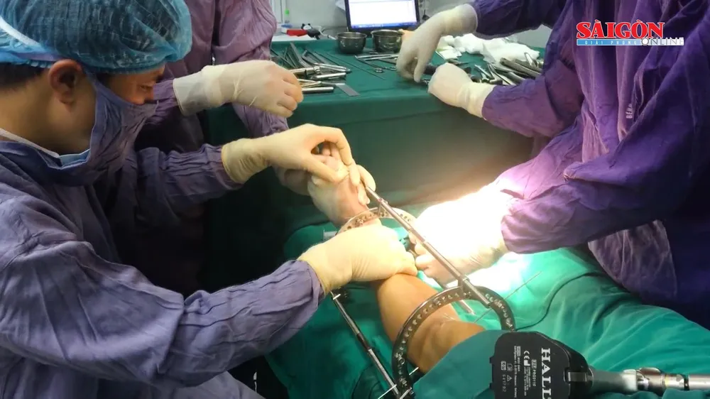 Bất ngờ những ca kéo dài chân lên đến hơn 10cm