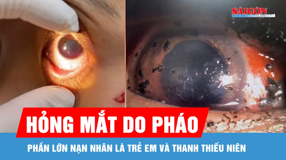 Tết Bính Ngọ 2026, nhiều người hỏng mắt do pháo