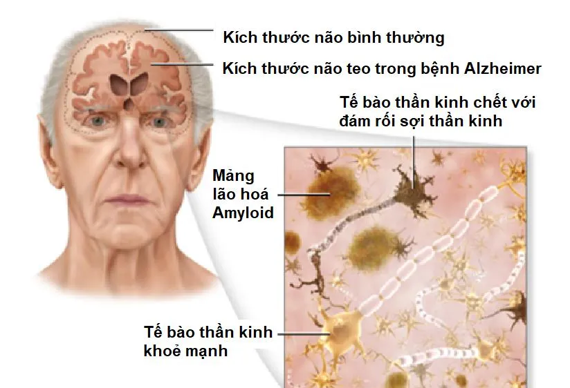 Cơ chế gây bệnh của bệnh Alzheimer và mức độ teo ở người bệnh Alzheimer