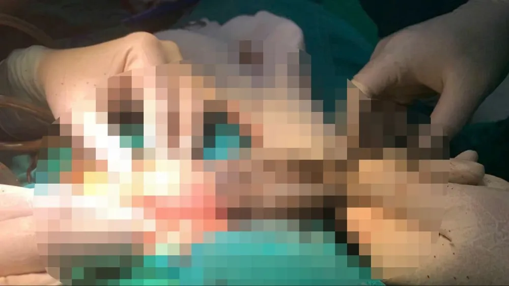 Các bác sĩ phẫu thuật lấy búi tóc và sợi vải ra khỏi dạ dày bé trai. Ảnh: Bệnh viện Nhi Thanh Hóa 