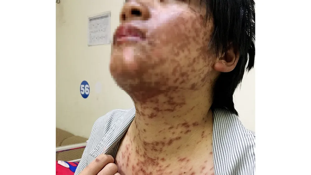 Những vết dị ứng do dùng thuốc tự ý lan rộng khắp cơ thể bệnh nhân