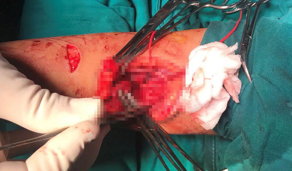 Bé gái rơi từ tầng 7 xuống đất bị đa chấn thương được cứu sống ngoạn mục