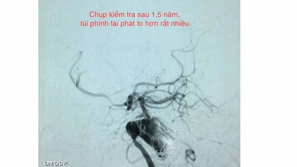 Can thiệp mạch máu não không cần gây mê