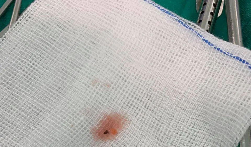 Viên đạn súng săn được lấy ra từ trong người bệnh nhi 