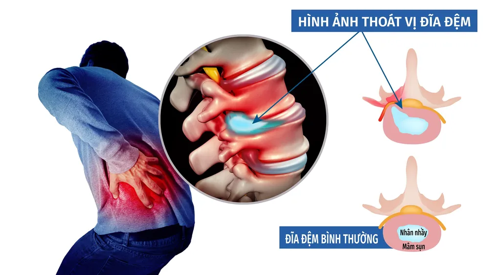 Thoát vị đĩa đệm, bệnh của cuộc sống hiện đại