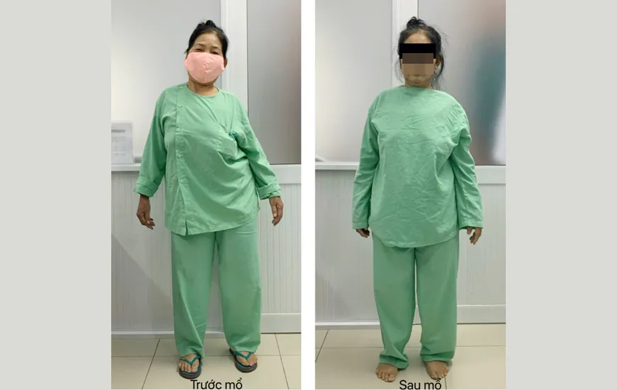 Phẫu thuật thành công một ca cong vẹo cột sống nặng, phức tạp