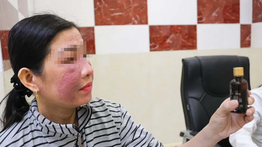 Bệnh nhân N.T.T.H bị viêm da tiếp xúc kích ứng do sử dụng mỹ phẩm trắng da cấp tốc mua trên mạng