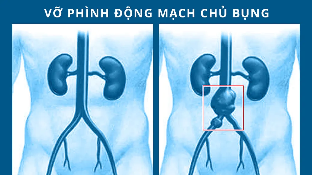 Cứu kịp thời cụ ông vỡ phình động mạch chậu chung 