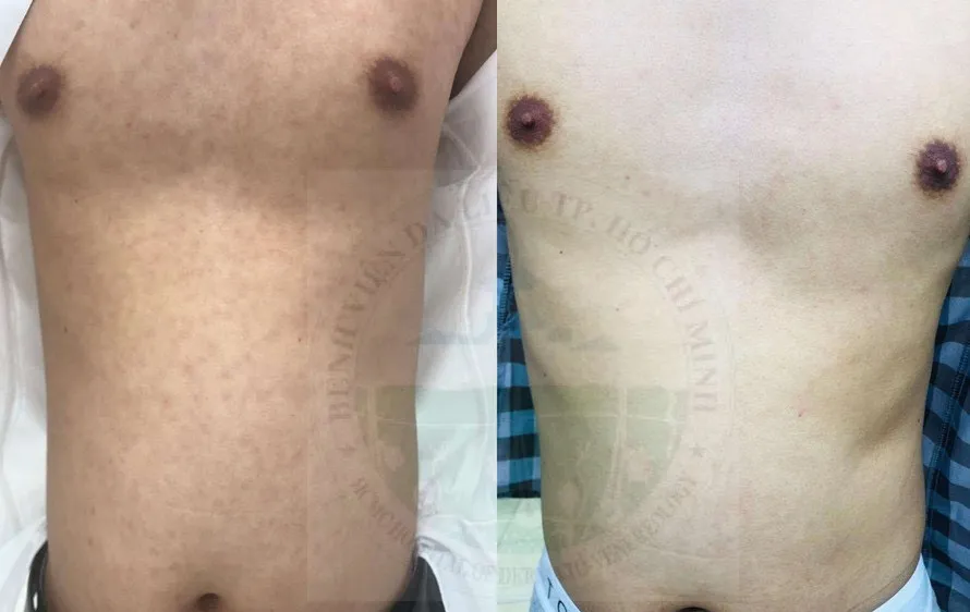 Phát hiện bệnh lý lây truyền qua đường tình dục hiếm gặp