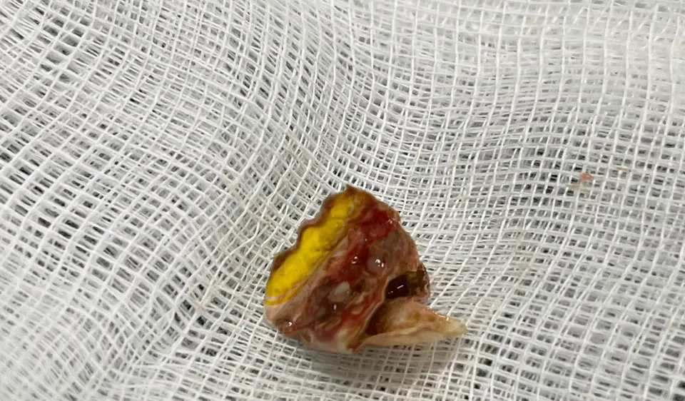 Vỏ kẹo nằm xếp lớp, gây tắc một nhánh thùy dưới phổi trái bệnh nhân