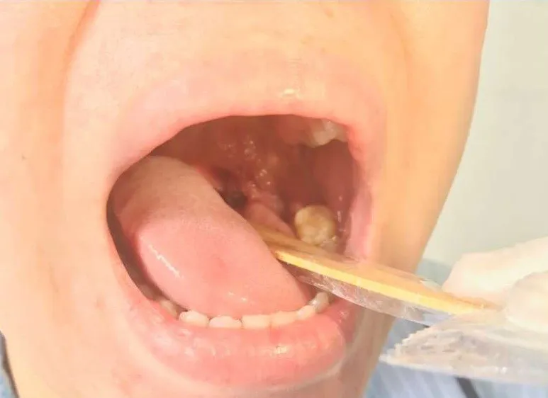 Bóng nước ở họng của bệnh nhân đã lành, hết đau