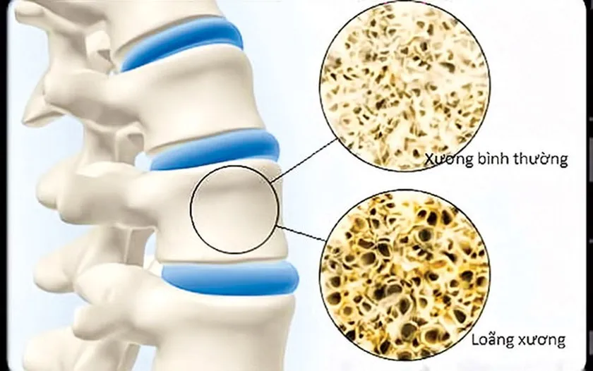 Bệnh loãng xương đang có xu hướng gia tăng nhanh