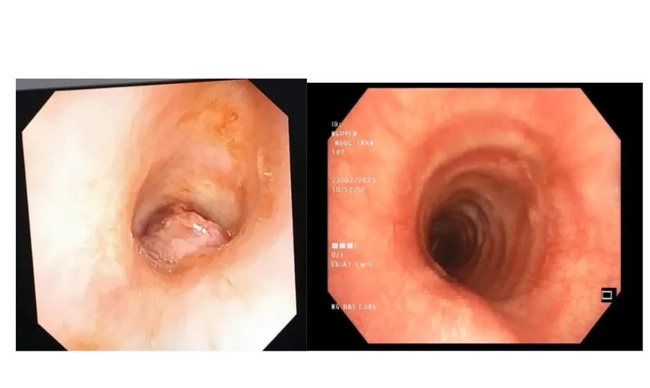 Coi chừng bít tắc khí quản do polyp 