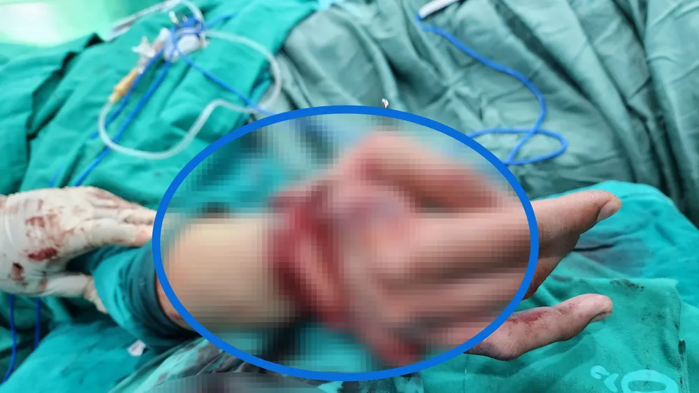 Bác sĩ đang thăm khám cho bệnh nhân sau phẫu thuật vi phẫu nối bàn tay đứt lìa