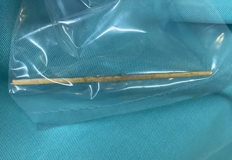 Gắp cây tăm nhọn dài 7cm nằm trong bụng bệnh nhi