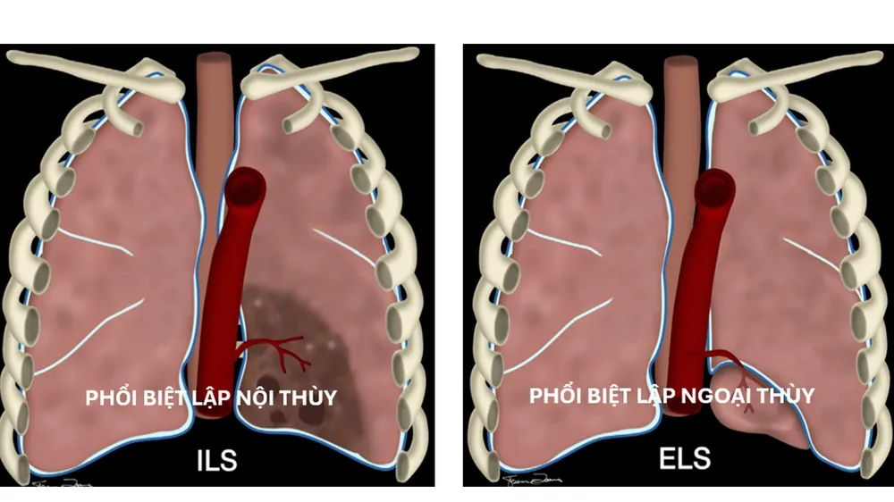 Minh hoạ phổi biệt lập nội thùy và ngoại thùy
