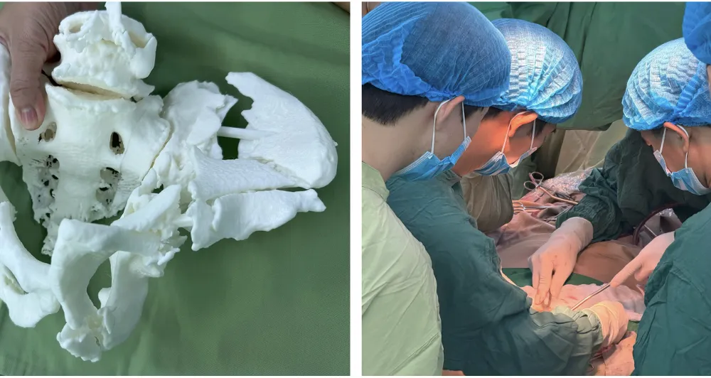 Ứng dụng công nghệ in 3D để tái tạo chính xác cấu trúc khung chậu của người bệnh trước mổ 
