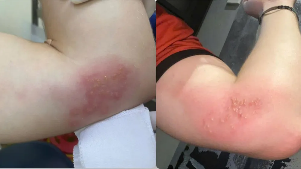 Các vết mụn nước, nhiễm trùng trên cánh tay người bệnh