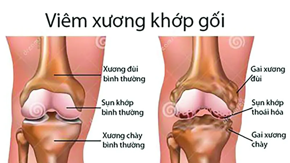 Từ biệt đau đớn do bệnh xương khớp