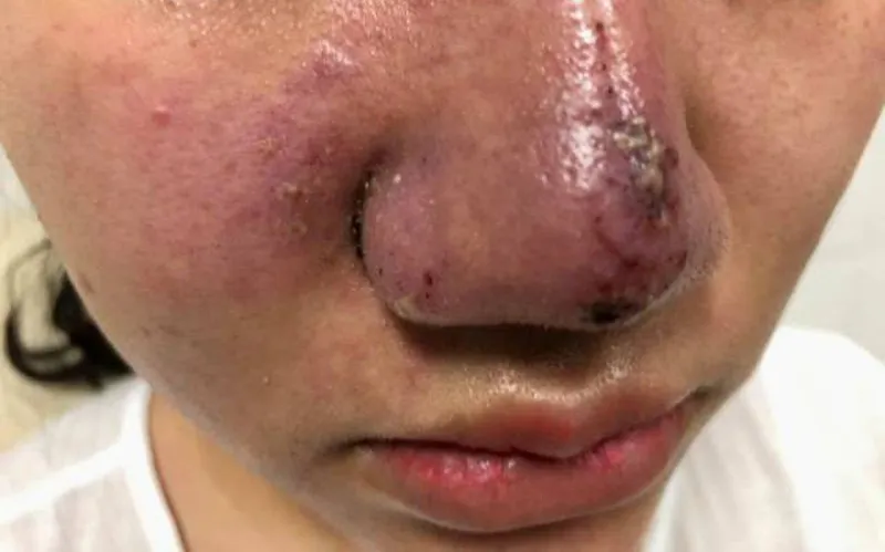 Nhiều trường hợp biến chứng do tiêm chất làm đầy