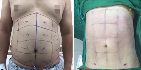 Tạo hình cơ thể - không đơn giản là phẫu thuật giảm mỡ