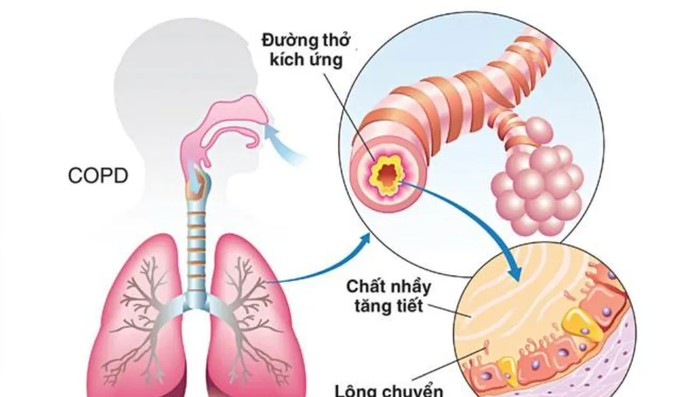 Bệnh phổi tắc nghẽn mãn tính - Sát thủ thầm lặng