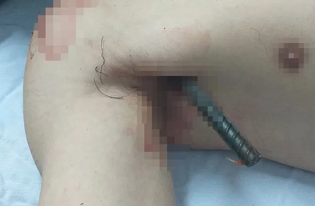 Phẫu thuật cứu thanh niên bị 2 thanh sắt đâm xuyên qua người