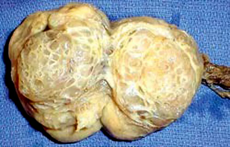 Tinh hoàn bị ung thư