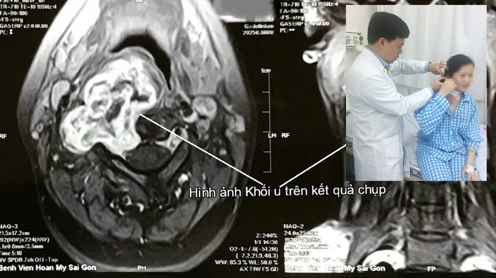 Giúp bệnh nhân bỏ u bao dây thần kinh cột sống cổ xâm lấn 