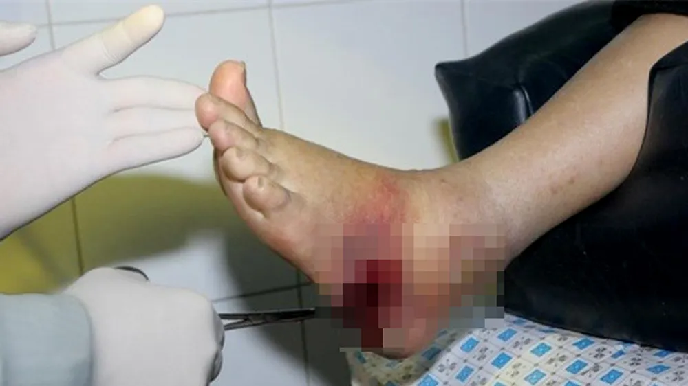 Phẫu thuật kịp thời chân bị nhiễm trùng nặng 