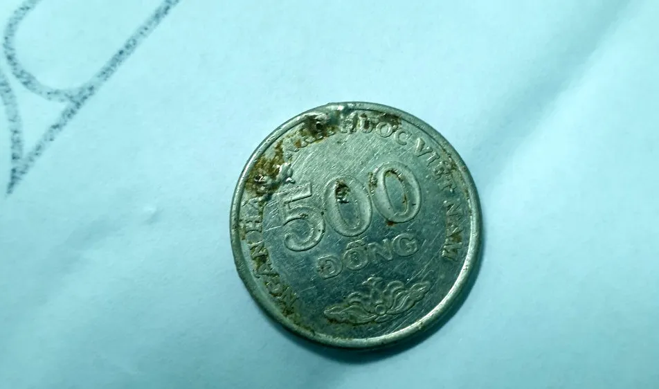 Gắp thành công đồng xu trong người bé gái 6 tuổi
