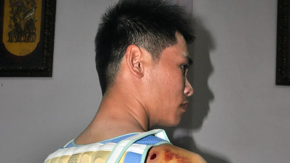 Anh Mậu bị đánh trọng thương ở lưng và vai. Ảnh CÔNG HOAN.