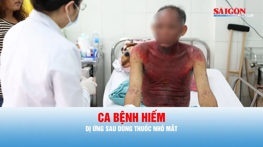Podcast tin thời sự ngày 14-8: Thuốc nhỏ mắt có thể gây phản ứng dị ứng toàn thân