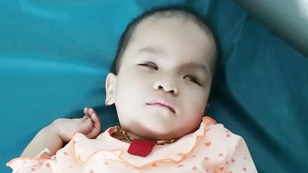 Xót xa bé gái 2 tuổi bị u võng mạc 2 mắt
