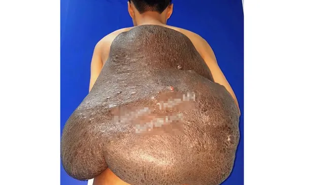 Chàng trai mang chiếc “mai rùa” suốt 26 năm được giải thoát kỳ diệu