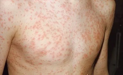 Số người mắc sởi tăng “chóng mặt“