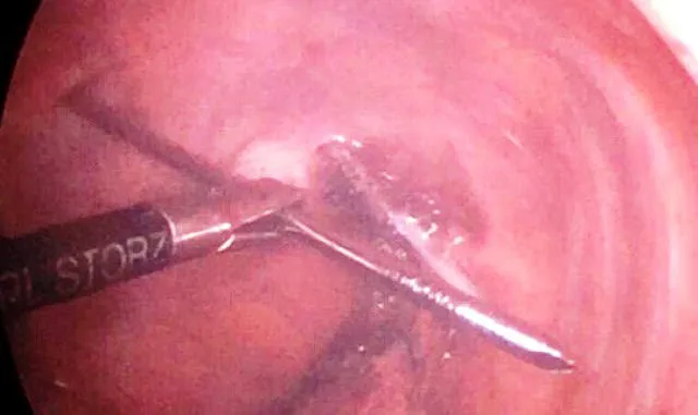 Hy hữu đinh dài 12 cm đâm xuyên đỉnh phổi chui vào tủy sống...vẫn sống