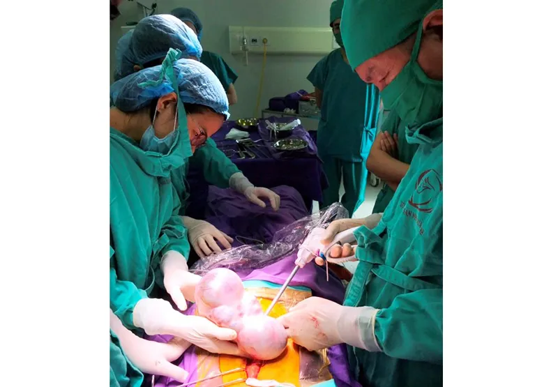 Khối u buồng trứng kỳ quái mang hình thù bào thai 2 đầu