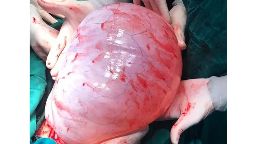 Thiếu nữ 22 tuổi “đốt ngải” để trị khối u buồng trứng gần 8 kg