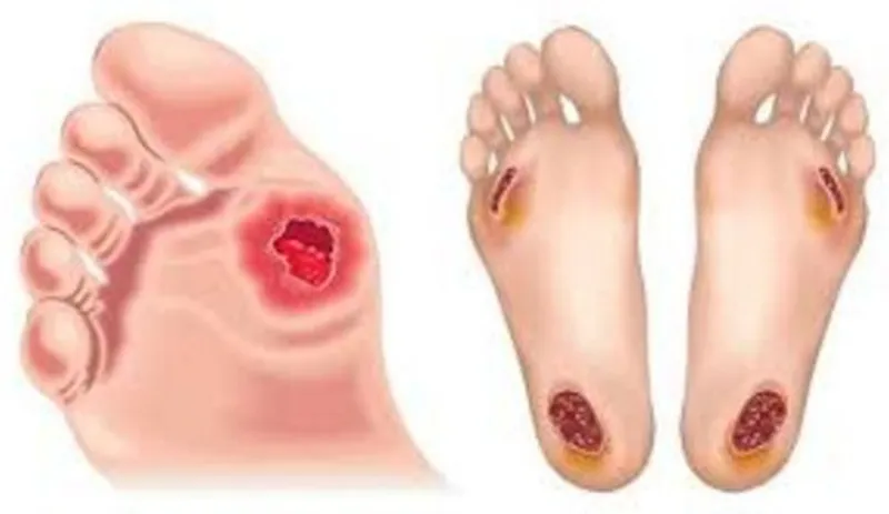 Ít nhất 80 người tử vong mỗi ngày vì biến chứng đái tháo đường