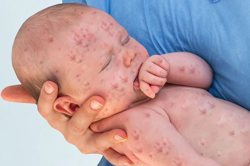 E ngại tiêm vaccine, dịch sởi bùng phát dữ dội