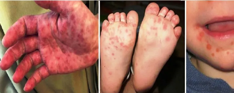 Bộ Y tế yêu cầu khẩn cấp phòng chống dịch bệnh tay chân miệng tăng đột biến 