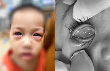 Hàng loạt trẻ nhỏ bị mắc dịch viêm kết mạc cấp bất thường