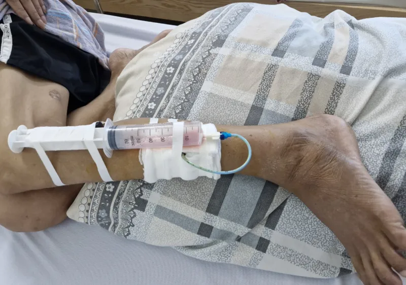 Liên tiếp ghi nhận nhiều trường hợp bị nhiễm vi khuẩn “ăn thịt người”