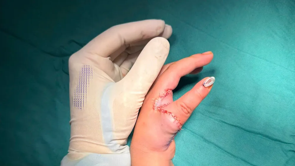 Biến ngón trỏ thành ngón cái: Phép màu y học giúp bé gái 5 tuổi tự cầm đũa, viết chữ