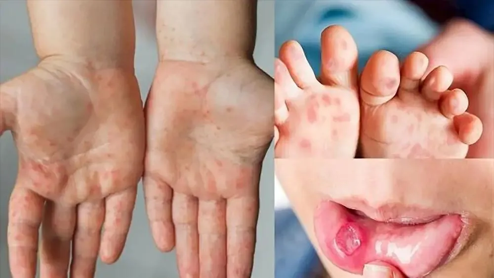 Gần 100.000 trẻ mắc tay chân miệng, Cục Phòng bệnh khuyến cáo khẩn