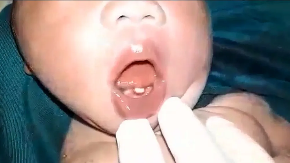 Một chiếc răng đã mọc lên ở hàm dưới của trẻ mới sinh