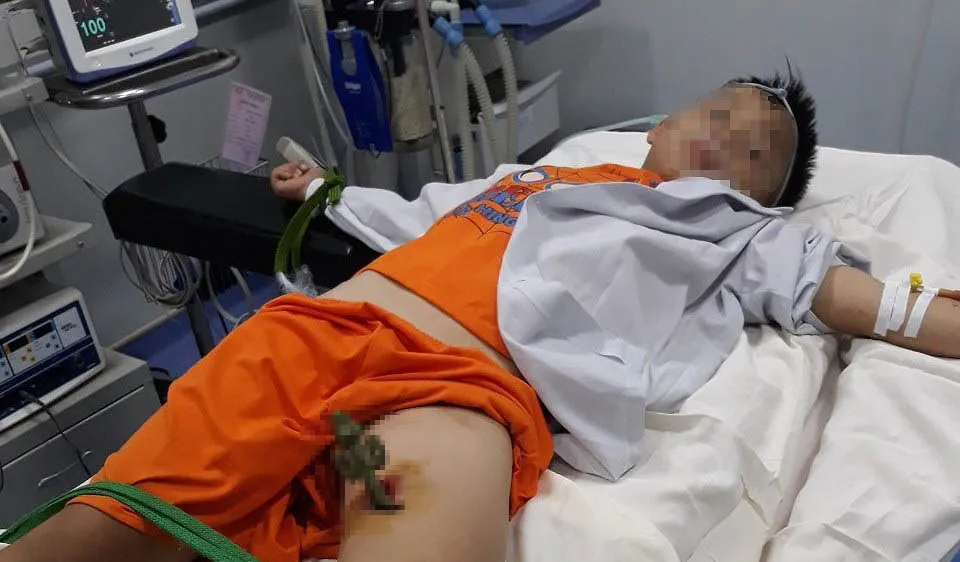 Mũi thanh sắt đâm vào đùi cháu Lê Văn Sáng